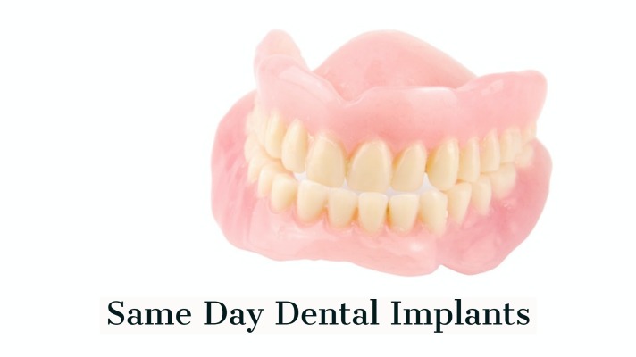 Same Day Dental Implants