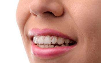 woman with aligners