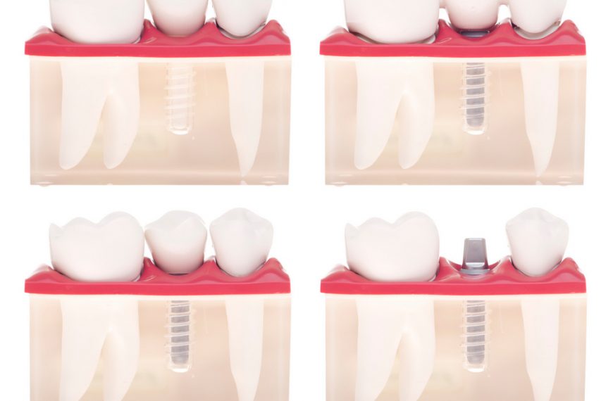 How Long Do Dental Implants Last?